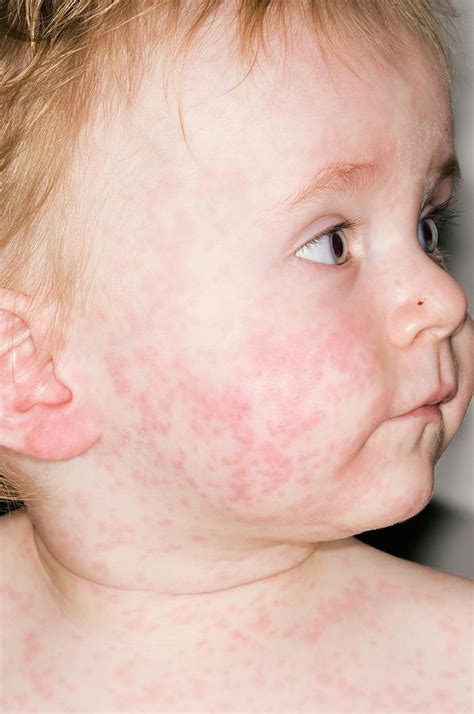skin rashes  face raised skin bumps pictures types