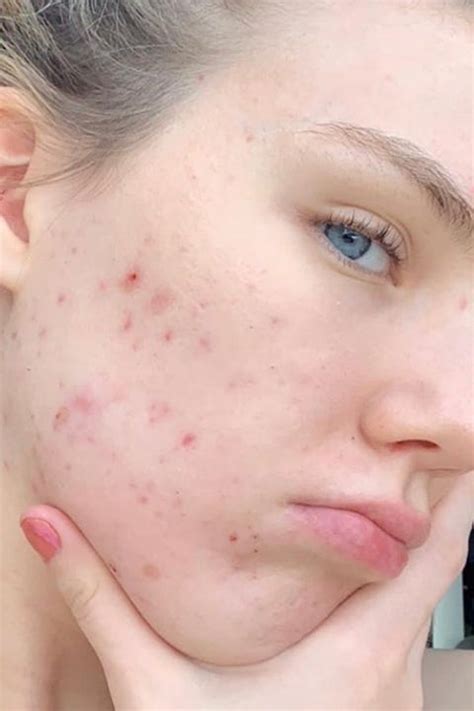 Accutane Before and After: 9 Women on Their Isotretinoin Side Effects