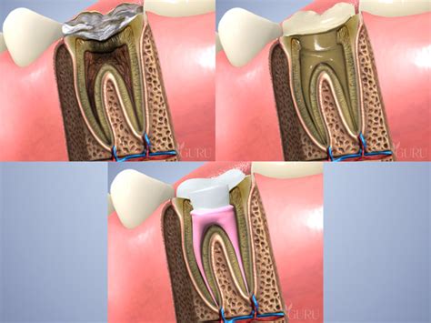 Dangers of a Damaged Tooth - Sedation and Implant Dentistry of Tehachapi with Jose David Sanchez ...