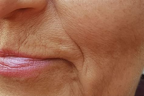 fine lines  wrinkles dermacore