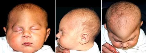Trigonocefalia - neurocirugia-infantil.com