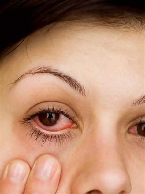 how to cure conjunctivitis at home