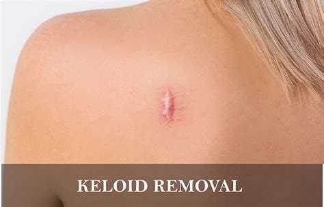 KELOID REMOVAL - Puro Clinic