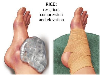 First aid - Sprain