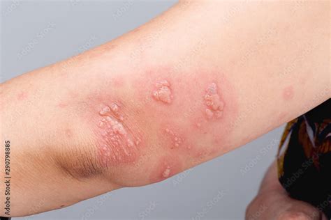 Shingles, Zoster or Herpes Zoster symptoms on arm ภาพถ่ายสต็อก | Adobe ...