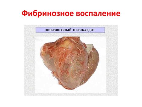Воспаление: определение, классификация, сущность, признаки, значение ...