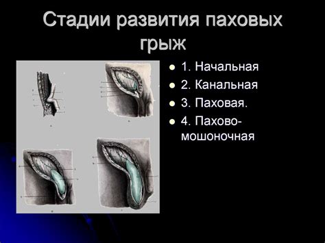 Грыжи живота: общая герниология, паховые, бедренные, пупочные грыжи ...