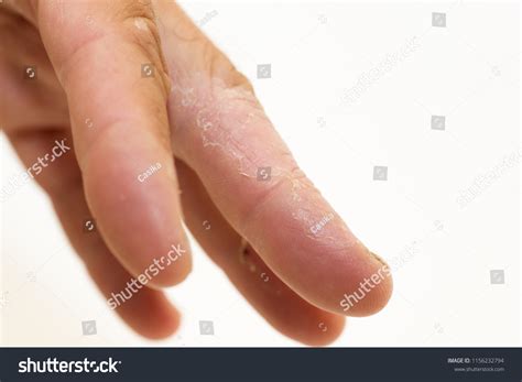 Left Middle Finger Atopic Stock Photo 1156232794 | Shutterstock