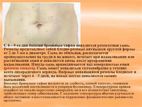 Как отличить аллергическую сыпь от сыпи при инфекциях - фото презентация