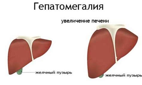 Гепатомегалия печени у взрослого — что это такое | Все о ЖКТ.ру