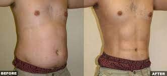 Liposuction in Dallas | Plano and Southlake Lipo Procedure in TX