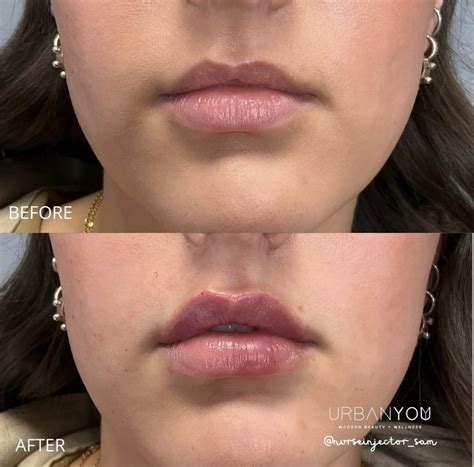 Lip Flip Botox Before And After Photos - Infoupdate.org