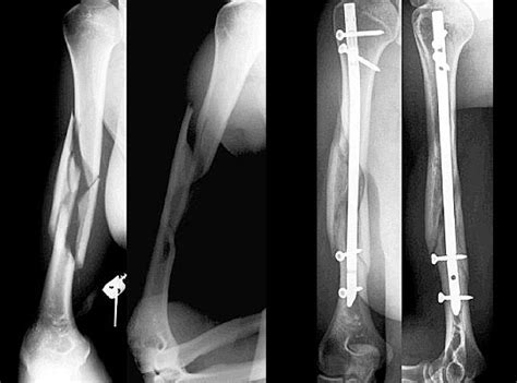Humerus Kırıkları | Op.Dr. Taner Bekmezci