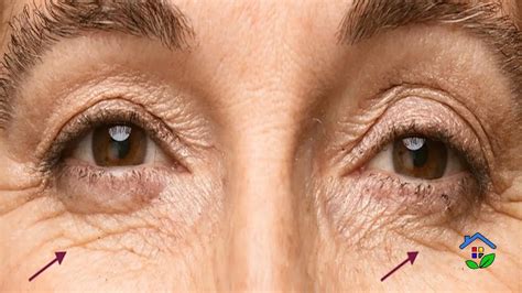 Combat Under-Eye Wrinkles With 3 Natural Remedies