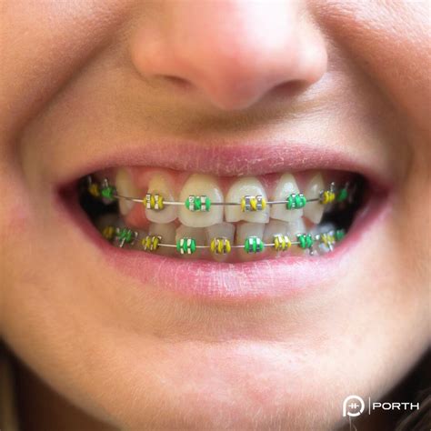 braces colour options