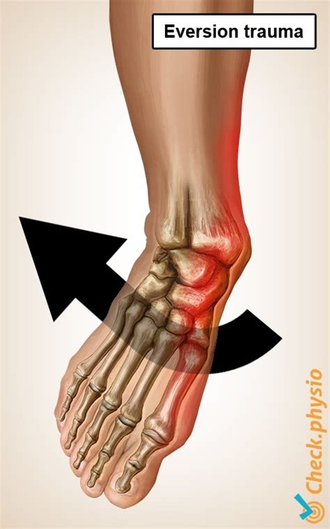 Medial ankle ligament injury | Physio Check