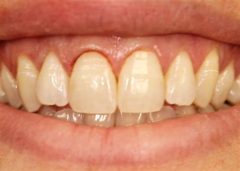 Benefit Of Laser Dental Treatment, NYC | Smile Arts Of NY