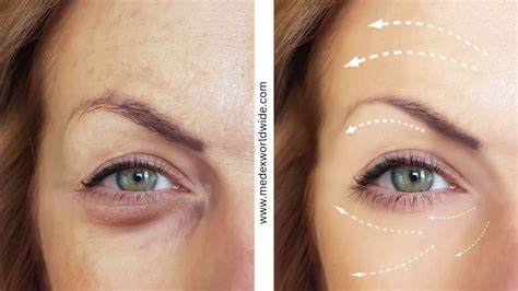 Timeless Elegance: Botox Before and After Transformations - Medex Worldwide