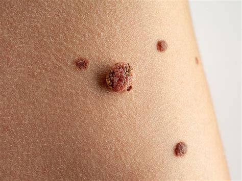 Malignant Melanoma | Stratum Dermatology Clinics