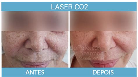 Laser Co2 Intimo Antes E Depois - Laser Co2 Antes E Depois 2022: Como Funciona, Saiba Tudo!