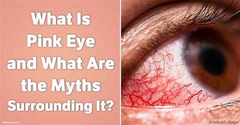 Pink Eye Causes Farting On Pillow at Mary Benally blog