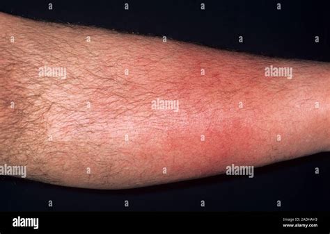 recurrent cellulitis    year  mans  leg cellulitis