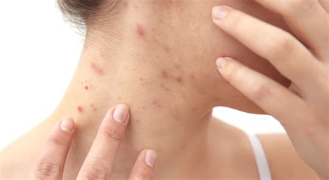 Back Of Neck Acne Treatment at Jennifer Varner blog