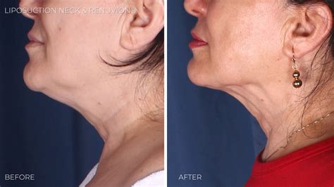 Neck Lift Alternatives: Surgical & Non-surgical Options | Omaha ...
