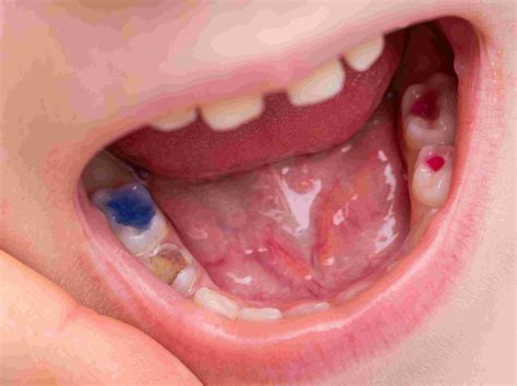 Tooth Colored Fillings | Composite Resin Fillings | Dr. Crooks