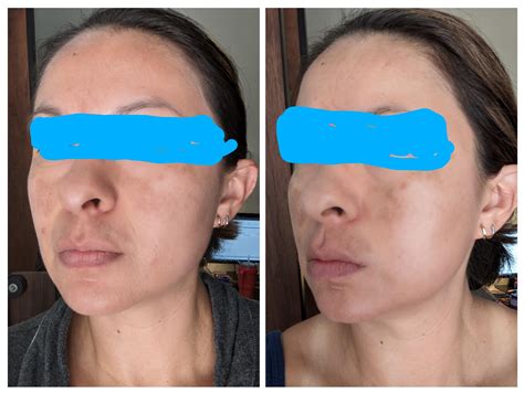Seeking advice to reduce dark spots. : r/tretinoin