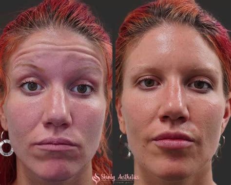 Botox Before and After Results - Everything You Need to See & Know