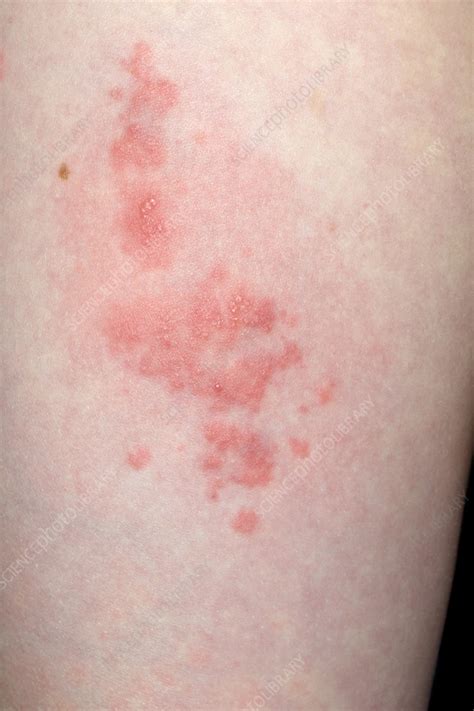 herpes zoster pictures  legs