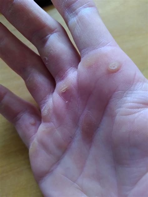 Any clue as to what these callus-like bumps (top right and pinkie