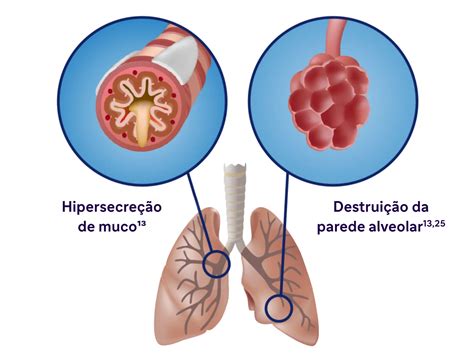 Inflamação Das Vias Aéreas - Papel da inflamação tipo 2 | Campus Sanofi