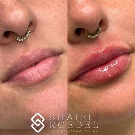 Preenchimento Labial 0 5 Ml Antes E Depois - Preenchimento labial antes e depois, veja transformações.