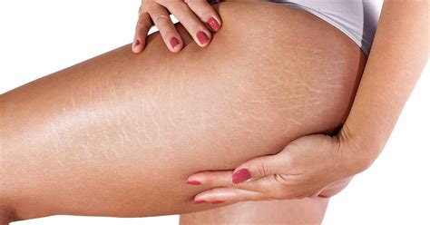 It Took a Health Crisis for Me to Embrace My Stretch Marks