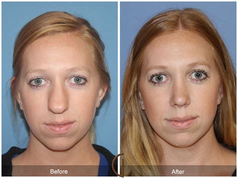 Septum And Turbinate Surgery