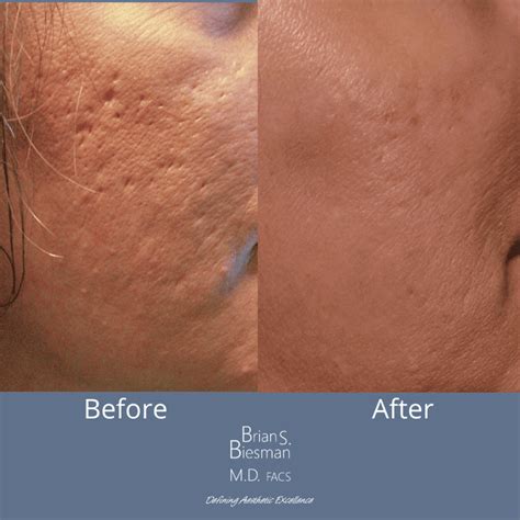 Types Of Acne Scars