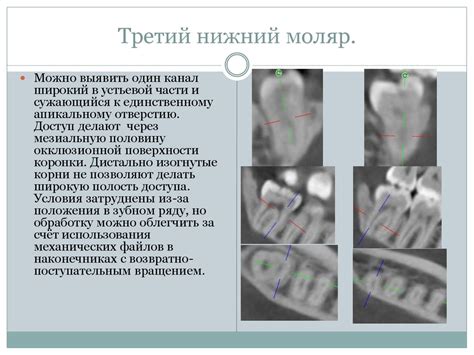 Морфология зубов и формирование эндодонтического доступа - презентация ...