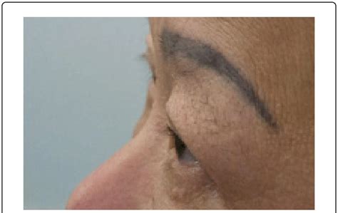 lateral view  months  prevention  scientific diagram