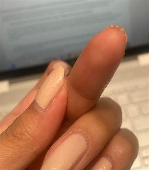 Weird fingernail fluid weeks after force trauma :( : r/DiagnoseMe