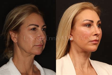 Vertical Deep Plane Facelift Before & After Photos by Dr. Ennis