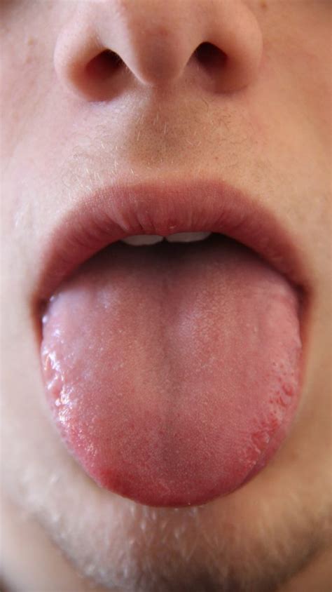 Tongue Discoloration: Symptoms, Causes, and Treatments - Aldie Family ...