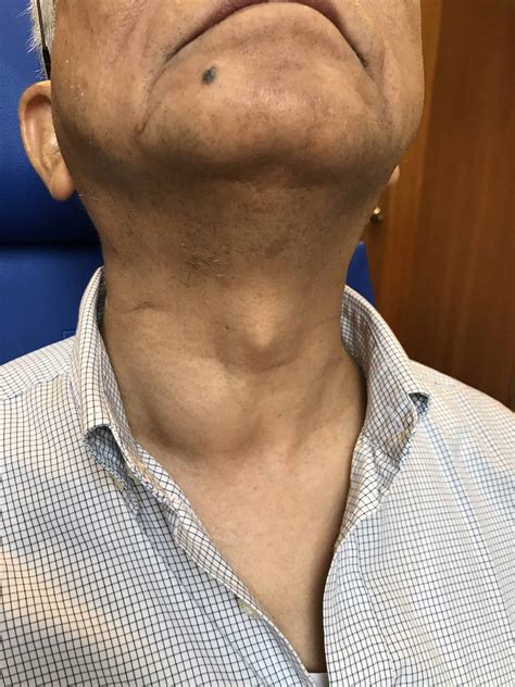 Dr. Dennis Chua’s Complete Guide to Neck Lump issues in Singapore