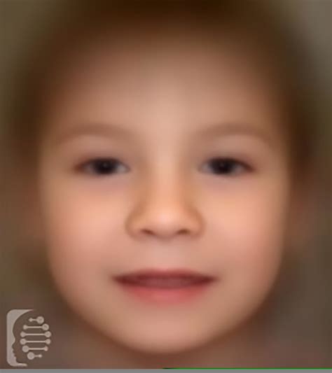 fetal alcohol face 1