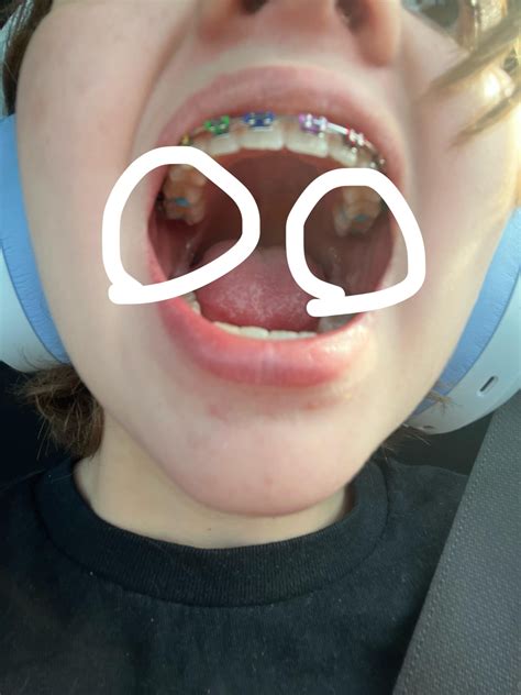 Please tell me they stop hurting after at most a day. : r/braces