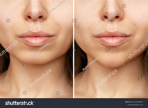 cleft chin surgery
