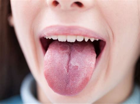 Pimples on Tongue, Under, on Tip, Side or Back and Getting Rid of ...