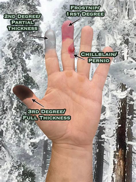 Understanding Frostbite — Thomas Coyne Survival Schools