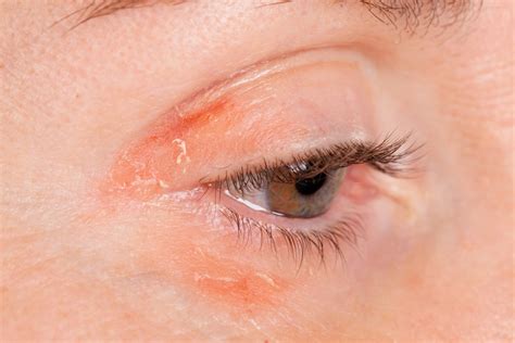 8 Tips for Dealing With Psoriasis on Your Eyelids | The Healthy